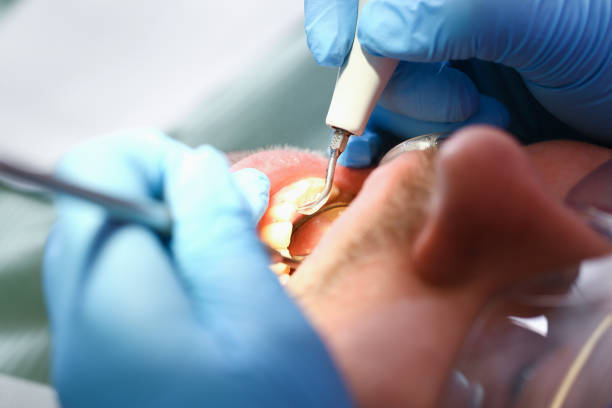 Best Emergency Dentist for Lost Fillings or Crowns in Brighton, IL